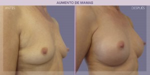 Before and after image of a breast augmentation procedure.